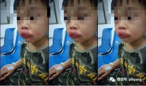 男孩吃葡萄過(guò)敏腫成嘟嘟嘴怎么回事？畫面詳情曝光網(wǎng)友忍不住笑了
