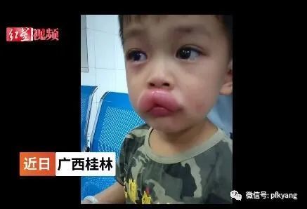 男孩吃葡萄過敏腫成嘟嘟嘴怎么回事？畫面詳情曝光網友忍不住笑了(圖5)